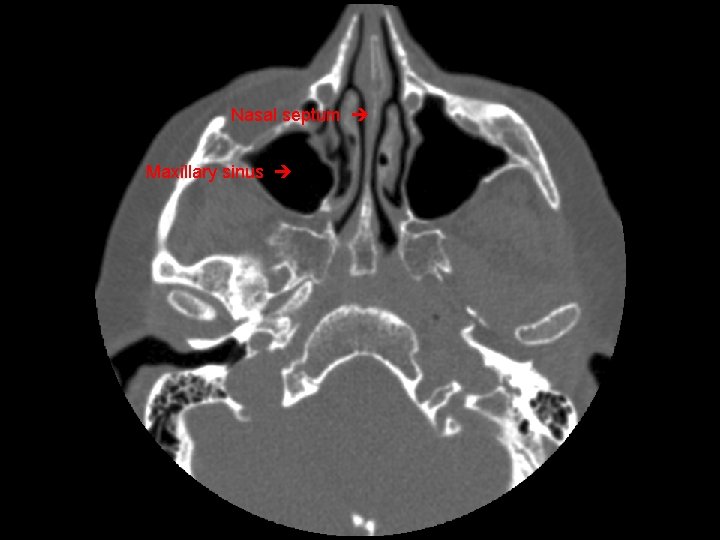 Nasal septum Maxillary sinus 