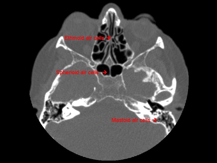 Ethmoid air cells Sphenoid air cells Mastoid air cells 