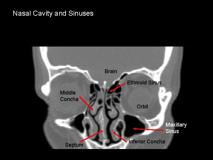 Nasal Cavity and Sinuses Brain Ethmoid Sinus Middle Concha Orbit Maxillary Sinus Septum Inferior