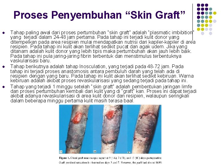 Proses Penyembuhan “Skin Graft” l l l Tahap paling awal dari proses pertumbuhan “skin