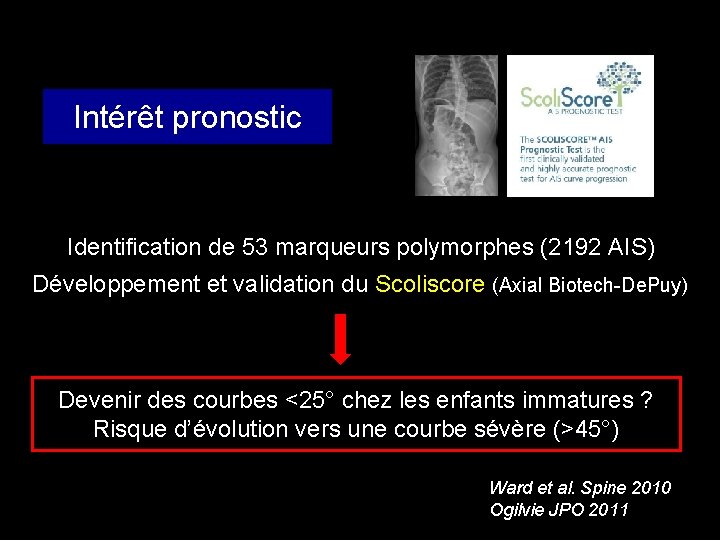 Intérêt pronostic Identification de 53 marqueurs polymorphes (2192 AIS) Développement et validation du Scoliscore