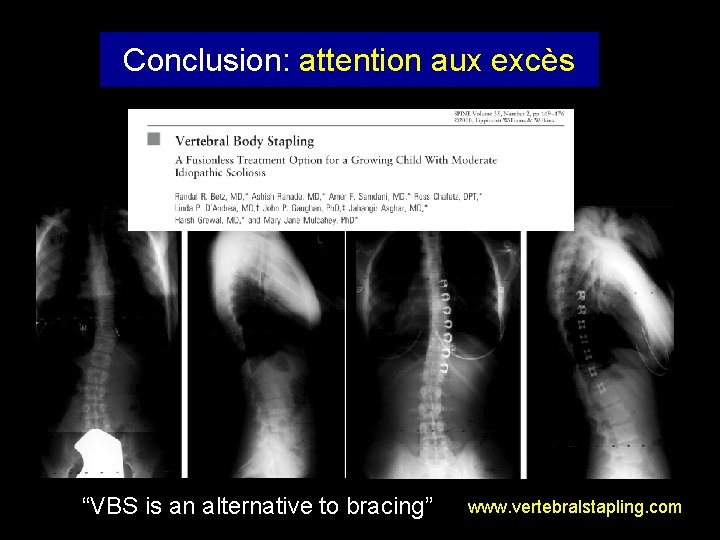 Conclusion: attention aux excès “VBS is an alternative to bracing” www. vertebralstapling. com 