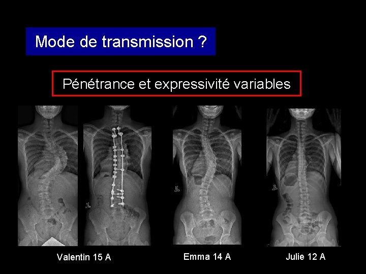 Mode de transmission ? Pénétrance et expressivité variables Valentin 15 A Emma 14 A