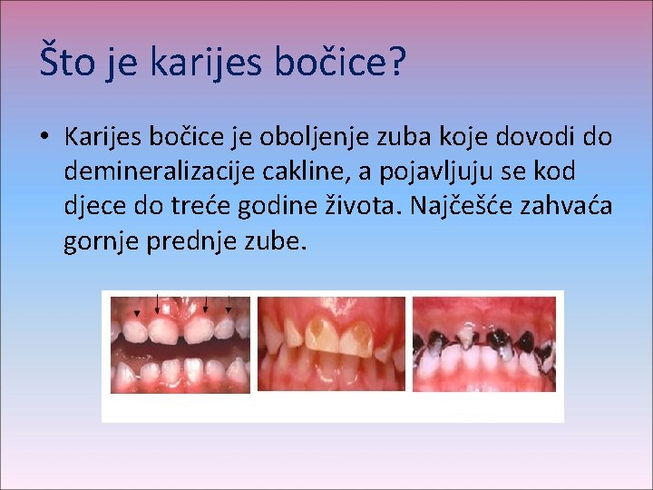 Što je karijes bočice? • Karijes bočice je oboljenje zuba koje dovodi do demineralizacije