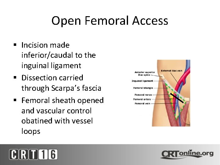 Open Femoral Access § Incision made inferior/caudal to the inguinal ligament § Dissection carried