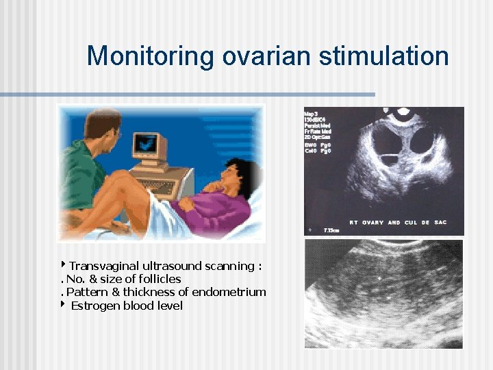 Monitoring ovarian stimulation Transvaginal ultrasound scanning : . No. & size of follicles. Pattern