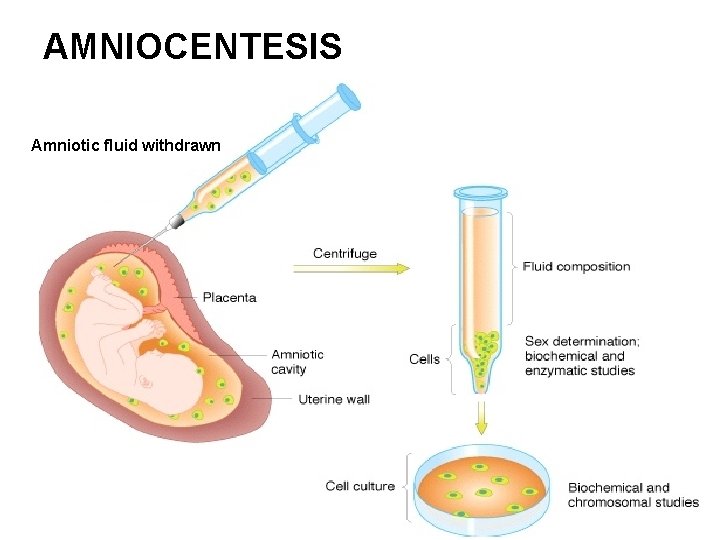 AMNIOCENTESIS Amniotic fluid withdrawn 