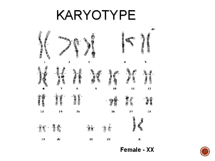 KARYOTYPE Female - XX 47 