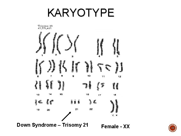 KARYOTYPE Down Syndrome – Trisomy 21 Female - XX 48 