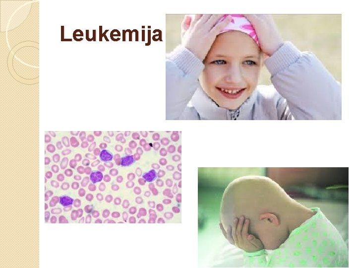 Leukemija 