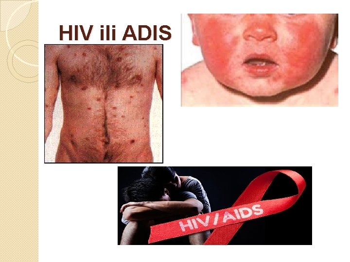 HIV ili ADIS 