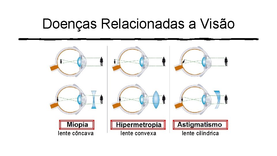 Doenças Relacionadas a Visão lente côncava lente convexa lente cilíndrica 