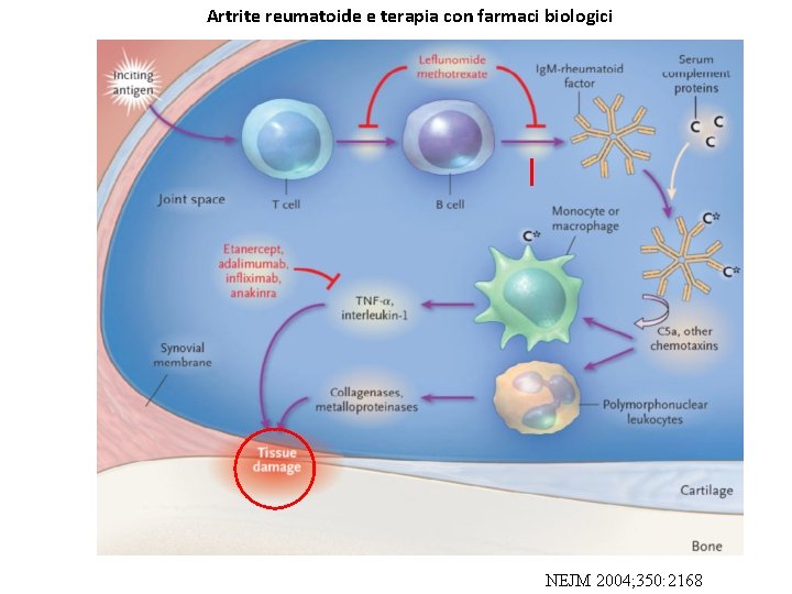 Artrite reumatoide e terapia con farmaci biologici NEJM 2004; 350: 2168 