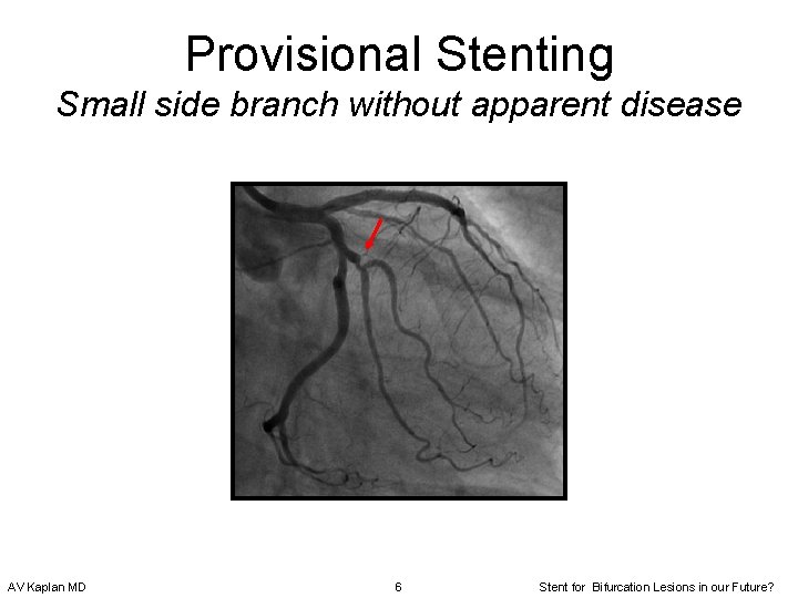 Provisional Stenting Small side branch without apparent disease AV Kaplan MD 6 Stent for