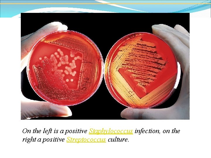 On the left is a positive Staphylococcus infection, on the right a positive Streptococcus