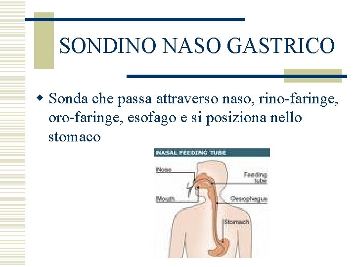 SONDINO NASO GASTRICO w Sonda che passa attraverso naso, rino-faringe, oro-faringe, esofago e si