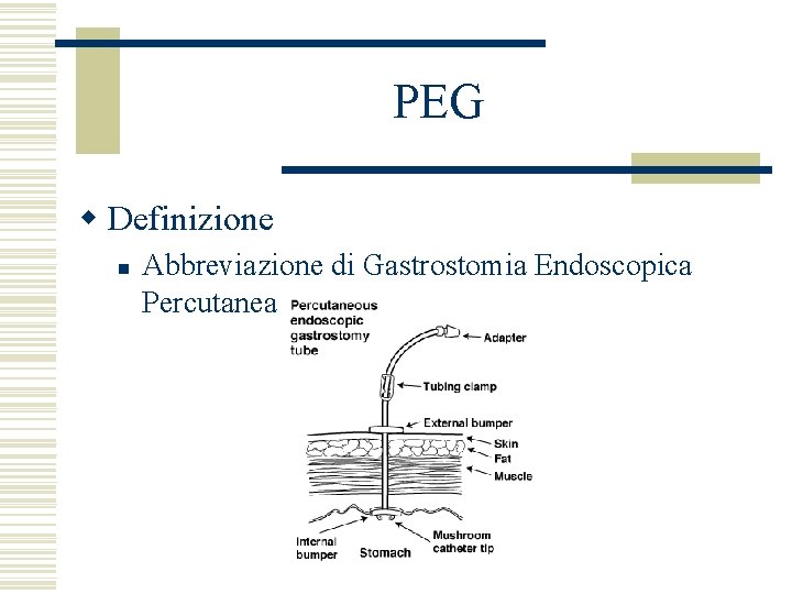 PEG w Definizione n Abbreviazione di Gastrostomia Endoscopica Percutanea 