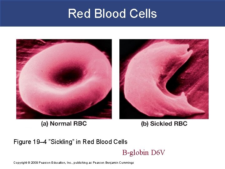 Red Blood Cells Figure 19– 4 ”Sickling” in Red Blood Cells B-globin D 6