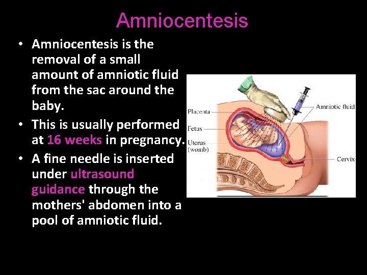 Amniocentesis • Amniocentesis is the removal of a small amount of amniotic fluid from
