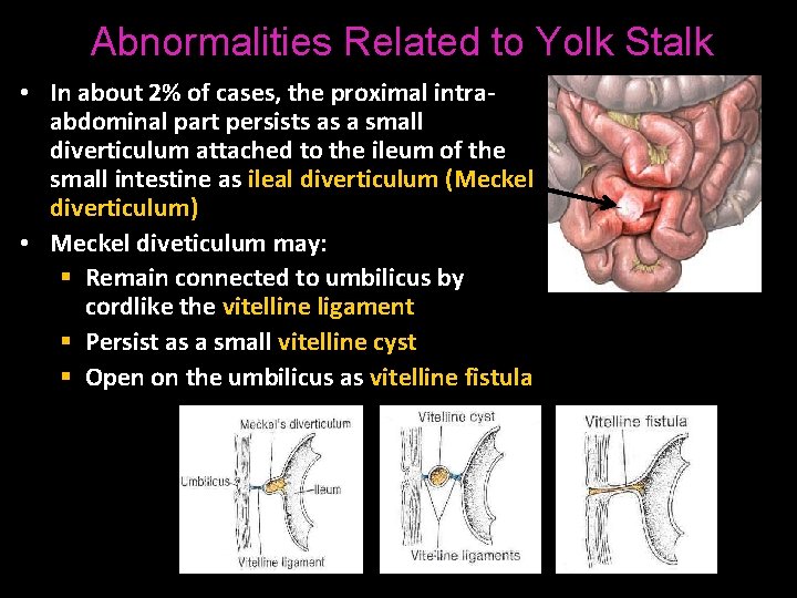 Abnormalities Related to Yolk Stalk • In about 2% of cases, the proximal intraabdominal