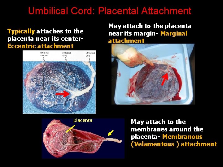 Umbilical Cord: Placental Attachment Typically attaches to the placenta near its center. Eccentric attachment