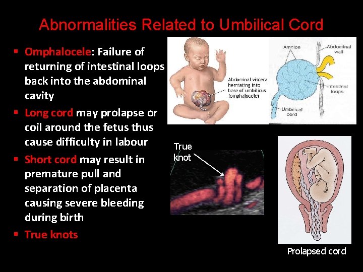 Abnormalities Related to Umbilical Cord § Omphalocele: Failure of returning of intestinal loops back