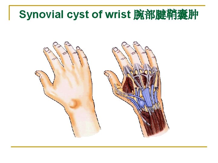 Synovial cyst of wrist 腕部腱鞘囊肿 