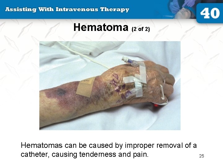 Hematoma (2 of 2) Hematomas can be caused by improper removal of a catheter,
