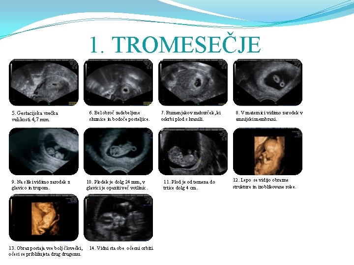 1. TROMESEČJE 5. Gestacijska vrečka velikosti 4, 7 mm. 9. Na sliki vidimo zarodek