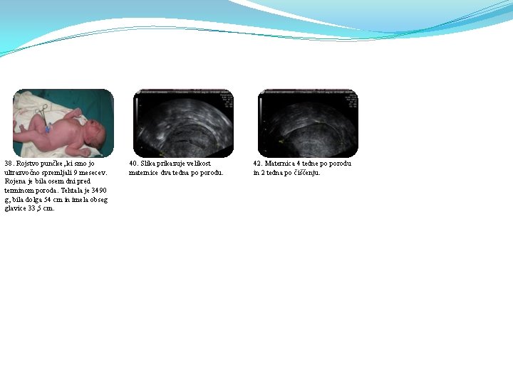 38. Rojstvo punčke, ki smo jo ultrazvočno spremljali 9 mesecev. Rojena je bila osem