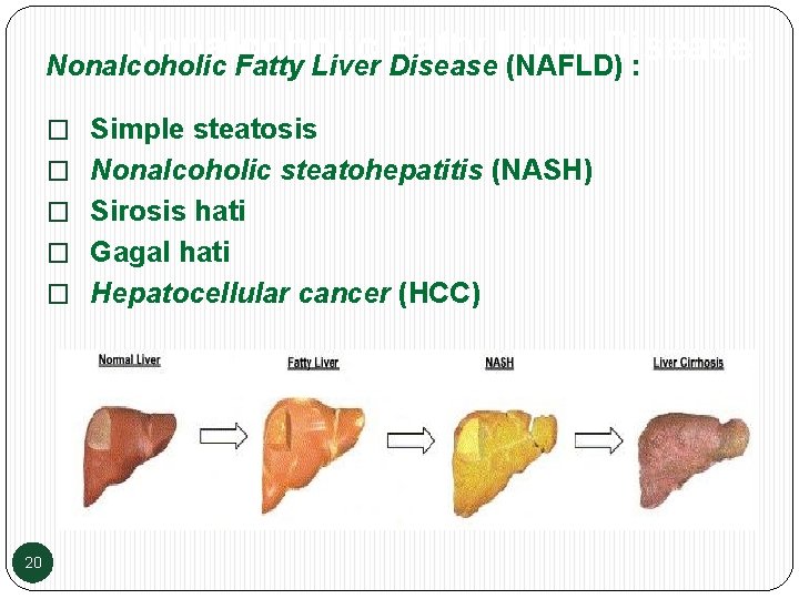 Nonalcoholic Fatty Liver Disease (NAFLD) : � Simple steatosis � Nonalcoholic steatohepatitis (NASH) �