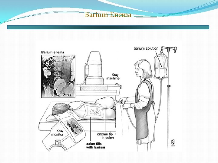 Barium Enema 