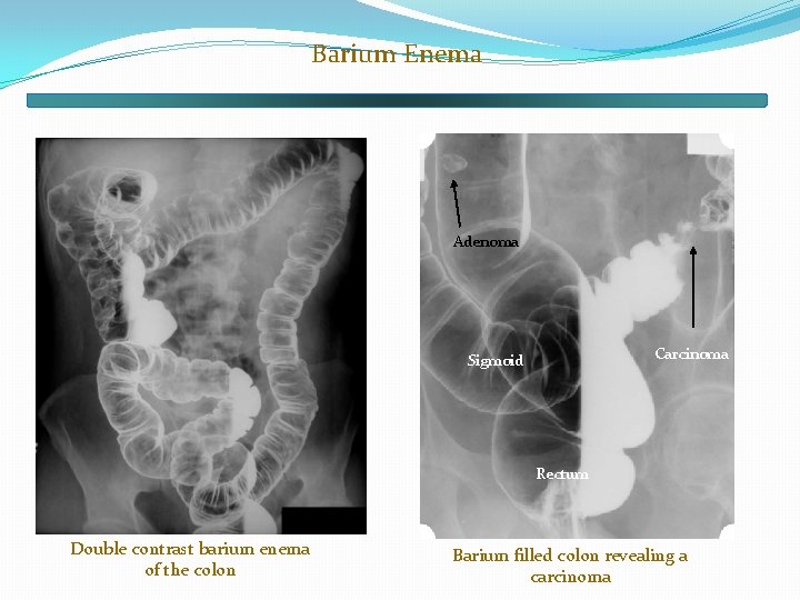 Barium Enema Adenoma Carcinoma Sigmoid Rectum Double contrast barium enema of the colon Barium