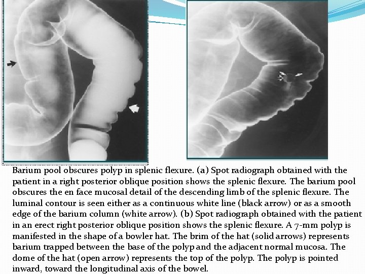 Barium pool obscures polyp in splenic flexure. (a) Spot radiograph obtained with the patient