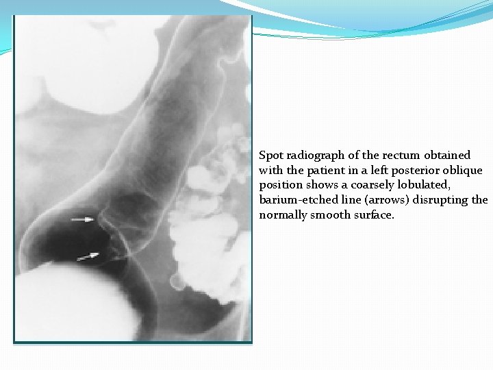 Spot radiograph of the rectum obtained with the patient in a left posterior oblique