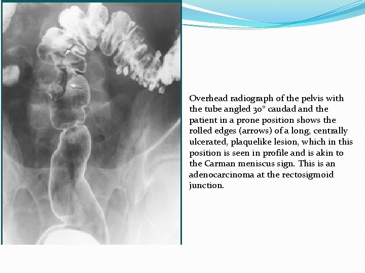Overhead radiograph of the pelvis with the tube angled 30° caudad and the patient