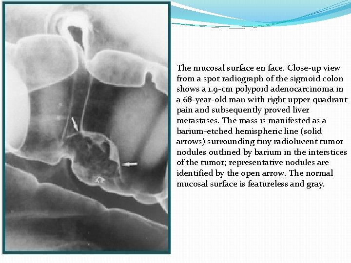 The mucosal surface en face. Close-up view from a spot radiograph of the sigmoid