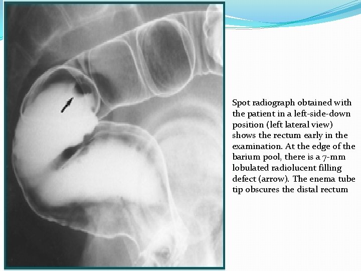 Spot radiograph obtained with the patient in a left-side-down position (left lateral view) shows