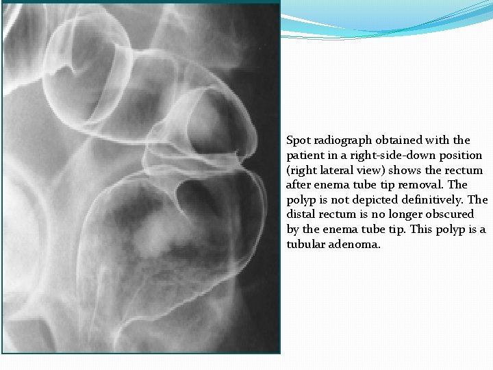 Spot radiograph obtained with the patient in a right-side-down position (right lateral view) shows