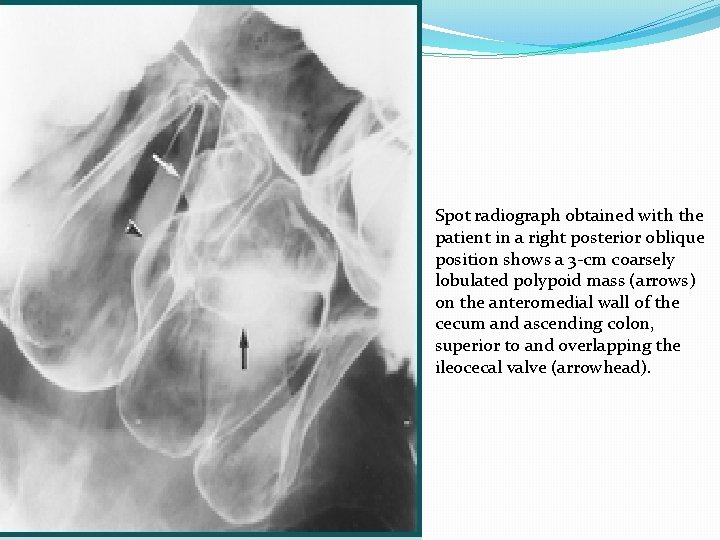 Spot radiograph obtained with the patient in a right posterior oblique position shows a