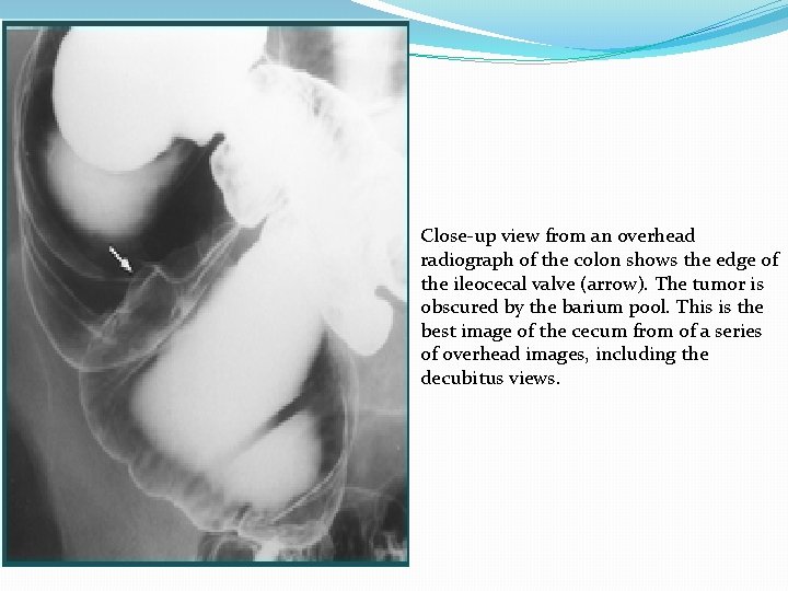 Close-up view from an overhead radiograph of the colon shows the edge of the
