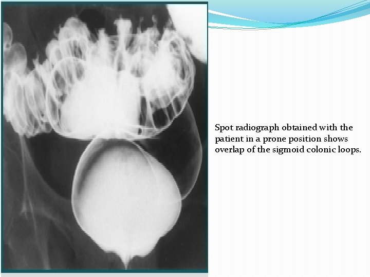 Spot radiograph obtained with the patient in a prone position shows overlap of the