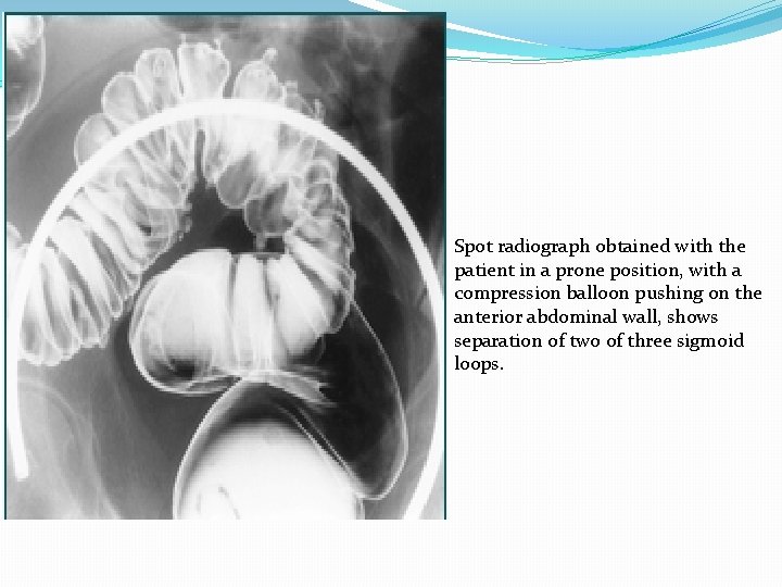 Spot radiograph obtained with the patient in a prone position, with a compression balloon