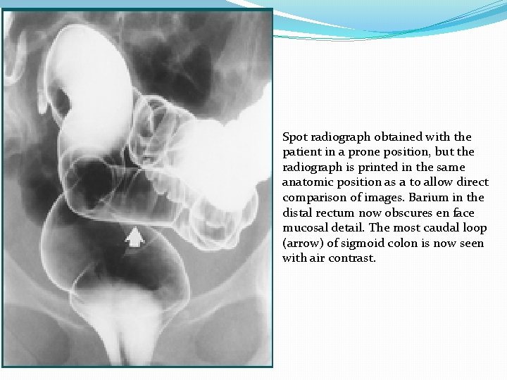 Spot radiograph obtained with the patient in a prone position, but the radiograph is