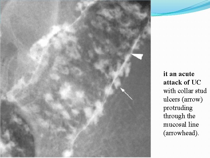 it an acute attack of UC with collar stud ulcers (arrow) protruding through the