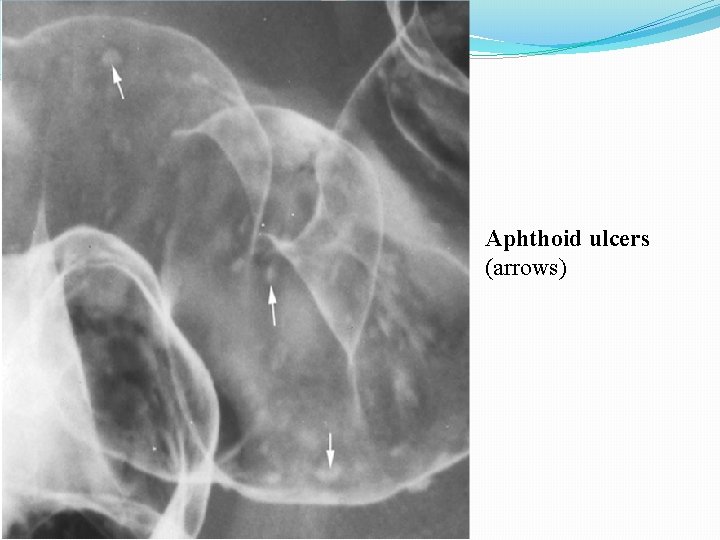 Aphthoid ulcers (arrows) 