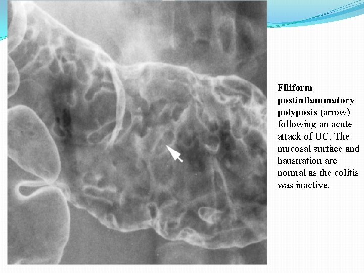 Filiform postinflammatory polyposis (arrow) following an acute attack of UC. The mucosal surface and