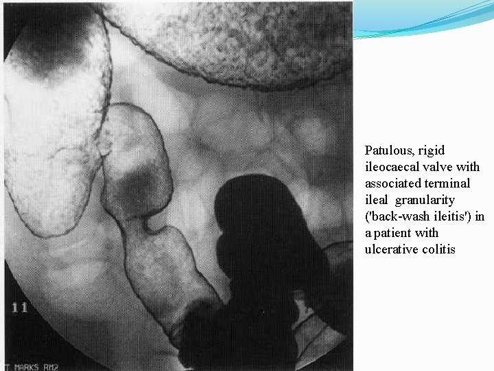 Patulous, rigid ileocaecal valve with associated terminal ileal granularity ('back-wash ileitis') in a patient