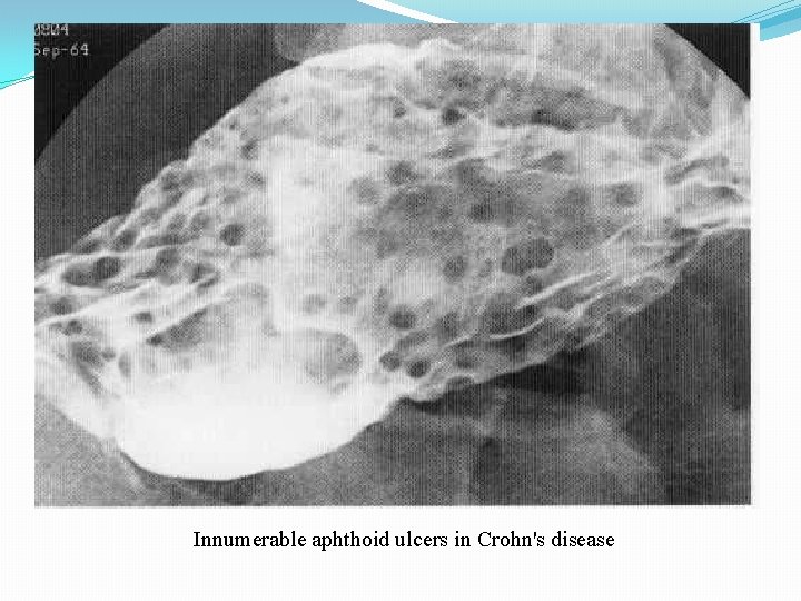 Innumerable aphthoid ulcers in Crohn's disease 