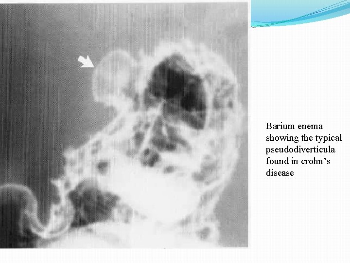 Barium enema showing the typical pseudodiverticula found in crohn’s disease 